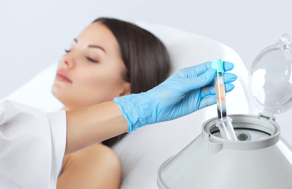 Plasma rico en plaquetas para tratamiento capilar